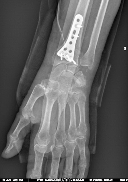 Fracture Poignet Dr Remi Chirurgien Orthopediste A Toulouse